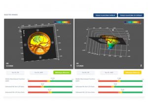 3D-Modell mit Farb- und Perfusionsanalysen von Retinalyze